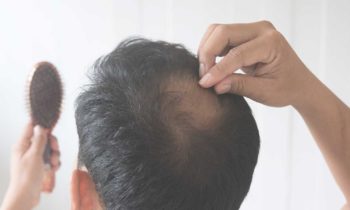 Caída del cabello en la alopecia androgénica: Tratamiento