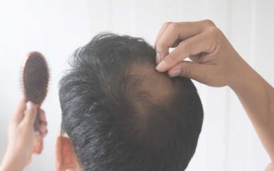 Caída del cabello en la alopecia androgénica: Tratamiento